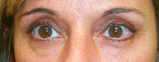 Before ā Age 44