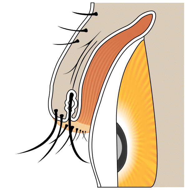 Distichiasis — second row of eyelashes