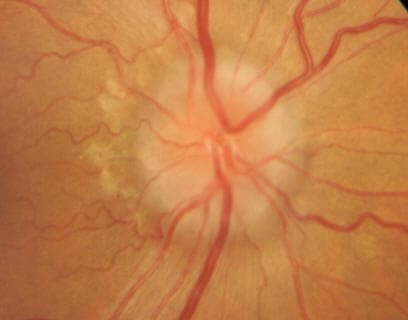 Optic disc edema in severe thyroid eye disease